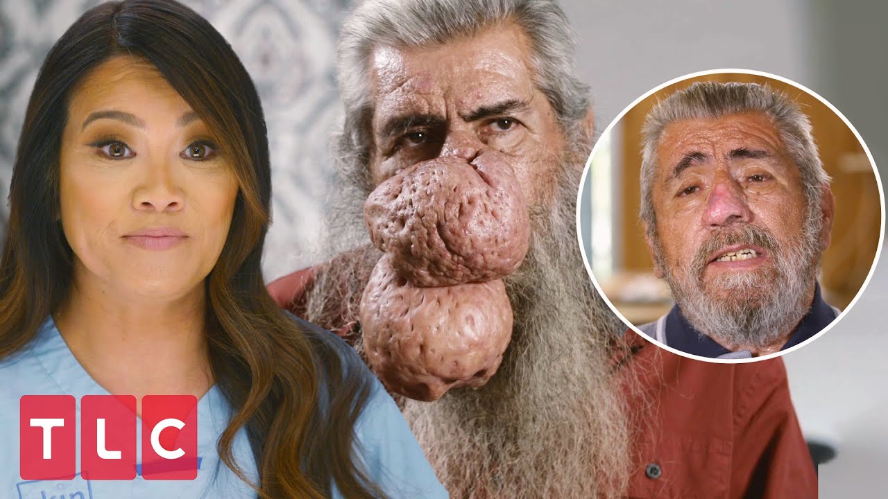 Dr. Pimple Popper treats severe rhinophyma: Check out Rogers nose results after surgery!