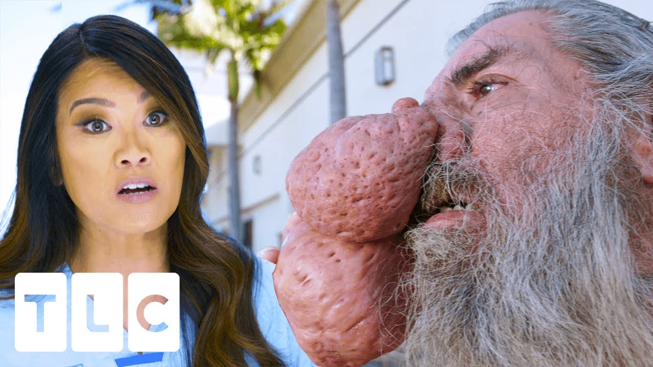 Dr. Pimple Popper treats severe rhinophyma: Check out Rogers nose results after surgery!
