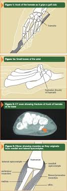 Golf Hand Injury Right Hand: Common Causes & Quick Fixes
