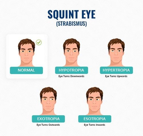 Kill Squint or Not: Easy Tips for Better Eye Comfort