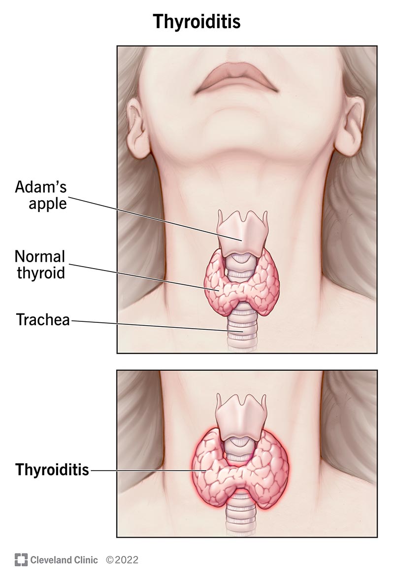 Thyroid Notch Pain: Common Causes (When to See a Doctor)