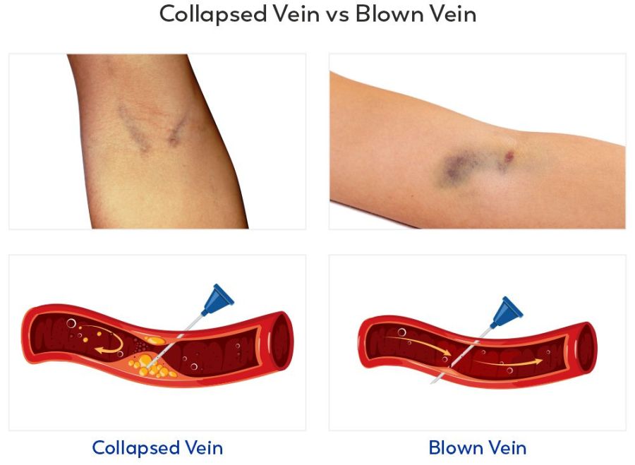 Why does a vein blow when drawing blood? Understanding the common causes and simple tips for patients.